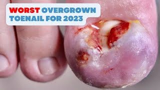 THE BESTWORST OVERGROWN TOENAIL FOR 2023 [upl. by Tom]