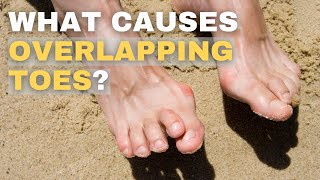 Overlapping Toes Causes and Solutions [upl. by Zeitler210]