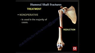 Humerus Fractures  Everything You Need To Know  Dr Nabil Ebraheim [upl. by Ecinahc]