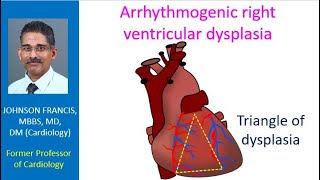 Arrhythmogenic right ventricular dysplasia [upl. by Bucher]