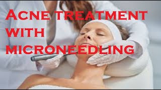 Acne treatment with microneedling [upl. by Giulio83]