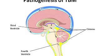 Pediatric DRTB Meningitis A CaseBased Discussion [upl. by Tierza]