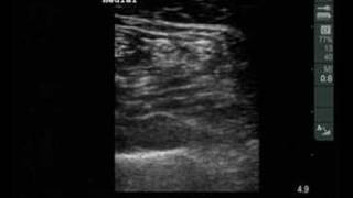 Ultrasound views of the sciatic nerve popliteal fossa [upl. by Ahcurb]