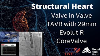 Valve in Valve TAVR with 29mm Evolut R CoreValve  January 8 2019 [upl. by Diego]