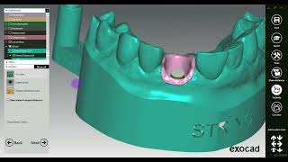 How to design a Digital Implant Model in exocad [upl. by Atirhs192]