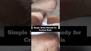 Remedies for cracked heels  crack heels home remedy cream youtubeshorts short [upl. by Eido425]