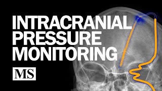 External Ventricular Drainage and Intracranial Pressure Monitoring [upl. by Ylagam]