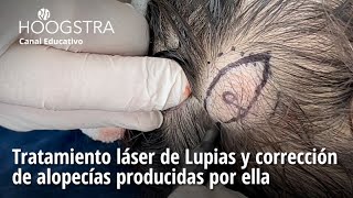 Tratamiento láser de Lupias y corrección de alopecías producidas por ella  24142 [upl. by Ahsatniuq]