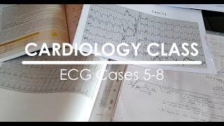 ECG  Flutter atriale bigeminismo TRNAV ripolarizzazione neurogena [upl. by Ancilin]