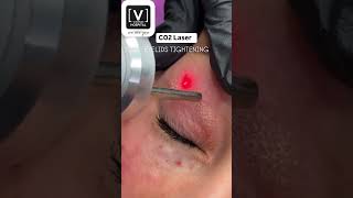 Co2 Laser Treatment  Eyelids Treatment  Best Derma Hospital in Kanpur [upl. by Anirbed769]