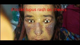 quotDISCOID LUPUS RASH ON CHEEKSquot [upl. by Vasily]