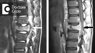 Can disc regenerate after Spinal Tuberculosis  Dr Mohan M R [upl. by Jammie]