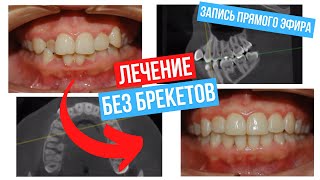 Invisalign  Лечение без брекетов Элайнеры Как работает система Разбор случая в прямом эфире [upl. by Hurst460]