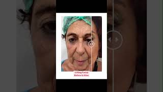 Înainte și după before and after operație Lifting Facial FaceLifting  Doctor Levy București [upl. by Annahael]