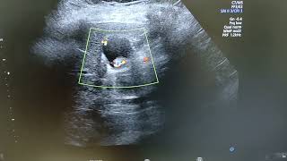 Adenomyomatosis  Comet tail artifacts  Choleithiasis [upl. by Silrac375]