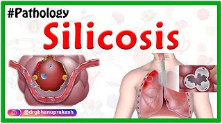 Silicosis Miners phthisis Grinders asthma  Etiology  Pathophysiology  Diagnosis Treatment [upl. by Hoffmann]