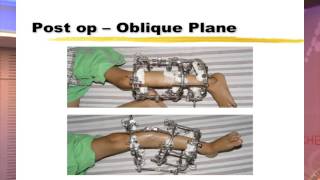 POSICON 2014 workshop on oblique plane deformity planning [upl. by Pearlstein]