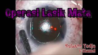 Operasi Lasik Mata Terbaru yang Dicari Mereka yang Berkacamata [upl. by Vernor649]