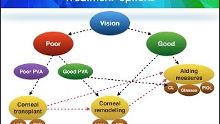 Quick Guide to the Management of Keratoconus Part 15 [upl. by Yesnek]