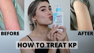 HOW TO GET RID OF KP ON ARMS  KERATOSIS PILARIS [upl. by Ielirol768]