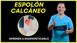 Advertencia ESPOLON CALCANEO y FASCITIS PLANTAR 😱 🦶🏻 [upl. by Renfred]