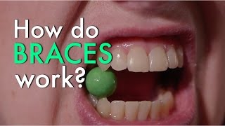 How Do Braces Work [upl. by Nnor463]