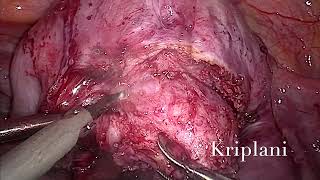 Prof Dr Alka Kriplani  laparoscopic adenomyomectomy [upl. by Elwood]