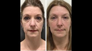 Under Eye Filler Before  After  Nashville Injector [upl. by Littell]