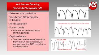 VT Ventricular Tachycardia vs SVT Supraventricular tachycardia with aberrancy [upl. by Abbub]