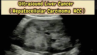 Liver Cancer  Hepatocellular Carcinoma HCC  Hepatoma Ultrasound [upl. by Odnumde]