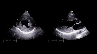 Initial Transthoracic Echocardiogram [upl. by Valerie]