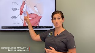 Treating Hip Bursitis  Regenerative options when traditional treatments stop working [upl. by Anirdna]