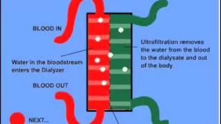 Hemodialysis Animation [upl. by Attenad]