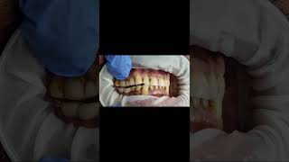 Lower implant molar bridge bite check with Bausch 40 micron articulating paper test shorts [upl. by Norvell]