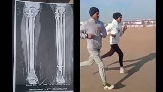 fullrecovery after tibia bone fracture [upl. by Adnilreb88]