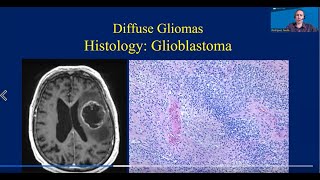 Understanding Neuropathology UCLA Brain Tumor Virtual Conference [upl. by Sjoberg]