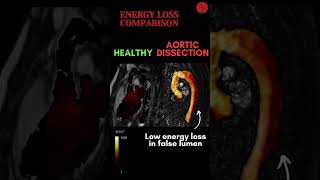 Aortic Dissection EnergyLoss [upl. by Ernie]