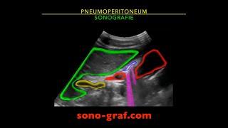 Sonographie  Pneumoperitoneum [upl. by Oj]