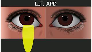 Relative Afferent Pupillary Defect  Medical Student Education [upl. by Eliezer]