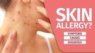 What is Skin Allergy Symptoms Causes Diagnosis and Triggers [upl. by Adnawuj]