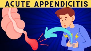 Acute Appendicitis Signs And Symptoms Risk Factors Diagnosis And Treatment [upl. by Eel]