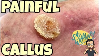 SATISFYING CALLUS REMOVAL FROM FEET [upl. by Nerraw]