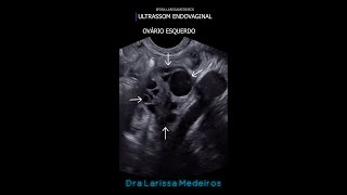 OVÁRIO ESQUERDO  Ultrassom endovaginal [upl. by Sutherland]