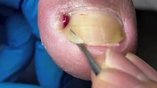 Deep Ingrown Nail Causes Infection Patient Feels Relief After Removal 【Yinuo Pedicure】 [upl. by Yud164]