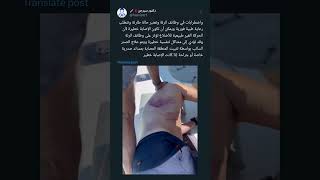 الصدر السائبflail chest دكتورسيرجن [upl. by Damiano]