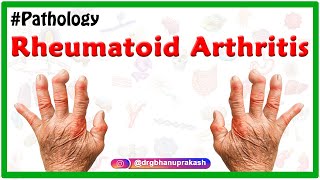 Rheumatoid arthritis Animation  Etiology Signs and Symptoms Pathology Diagnosis and Treatment [upl. by Kcub307]