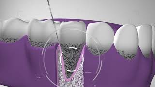 Curetaje higiene dental Te explicamos el procedimiento en Dentix [upl. by Eilla]