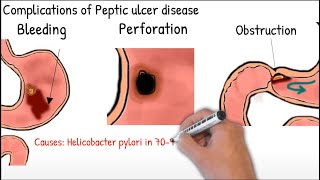 Gastric ulcer and duodenal ulcer in 2 minutes Peptic ulcer disease [upl. by Herstein246]