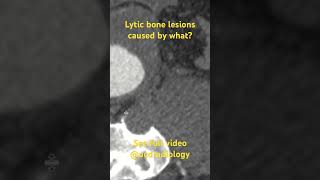 Lytic bone lesions caused by what doctor medicalstudent radiologyresident radiology radres [upl. by Ettelegna]