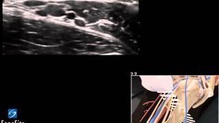 3D Lehrvideo Ultraschallgestützte Axilläre regionale Nervenblockade  SonoSite Ultraschall [upl. by Assiled]